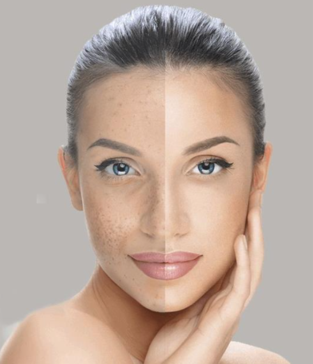 Top 5 Skin Whitening Treatments for Sensitive Skin