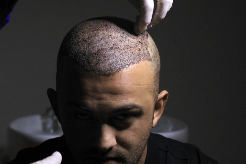 Can Hair Transplant Give a Fuller, Healthier Look?