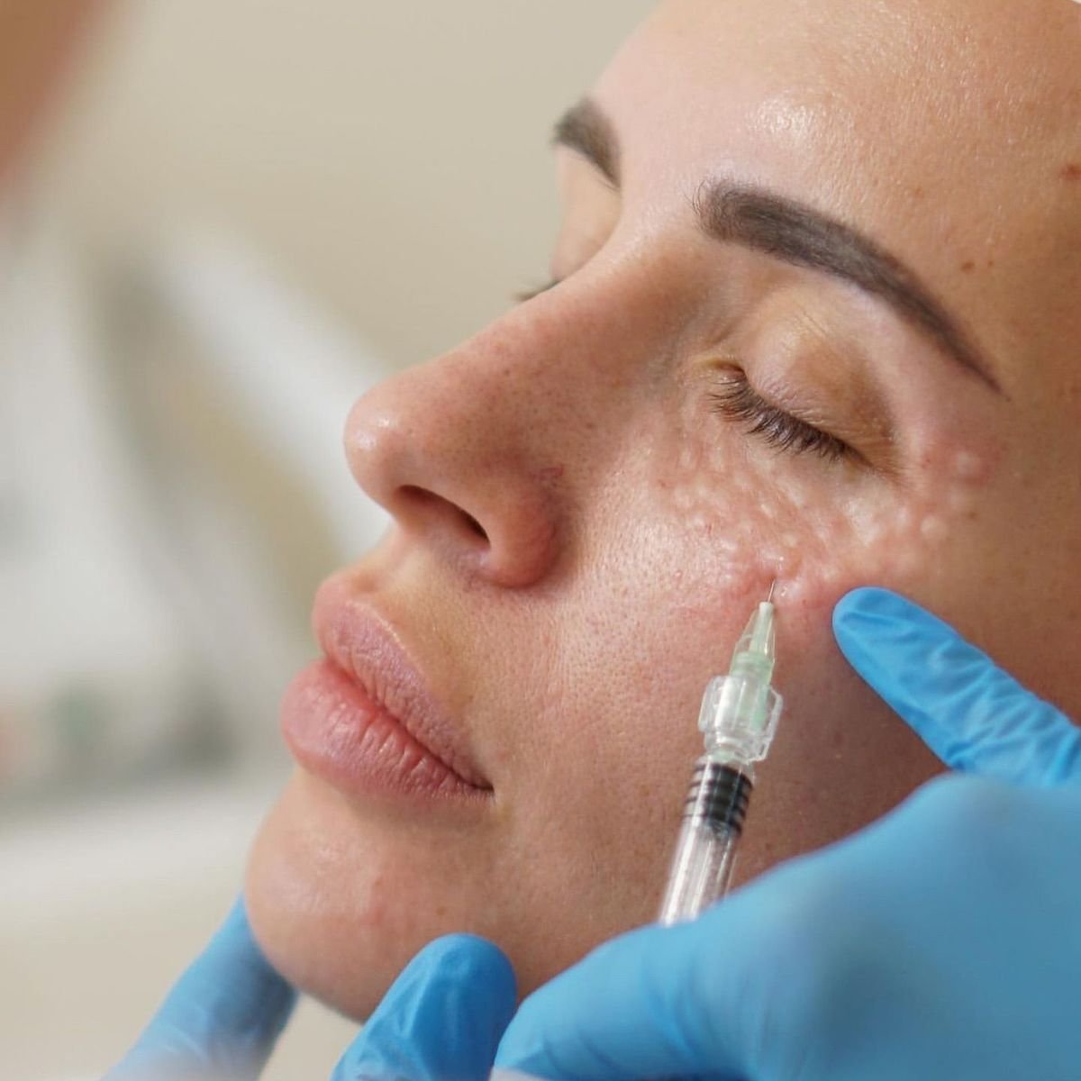 The Glow-Boosting Power of Botox