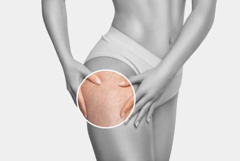 Why Do Stretch Marks Occur? How to Remove Stretch Marks Permanently